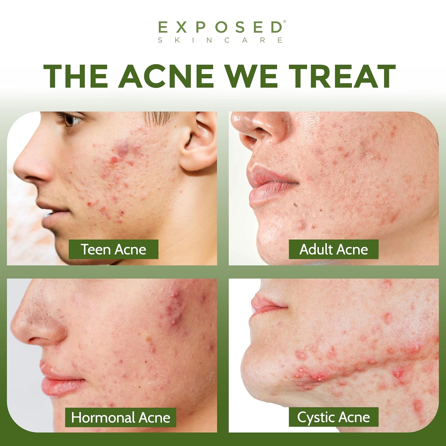 Clear Pore Serum – Banish Blackheads & Reduce Shine with 1% Salicylic Acid for Sensitive Skin - Image 2